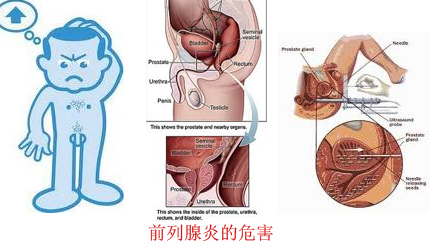 前列腺炎