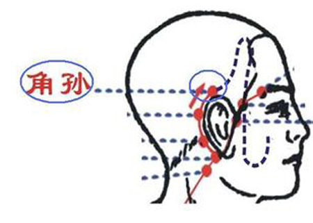 角孫穴→有效治療偏頭痛