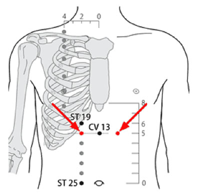 承滿穴→治胃痛、胃痙攣