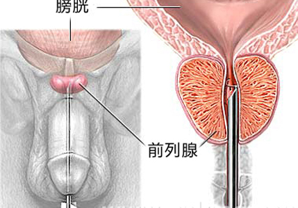 前列腺疾病有哪些