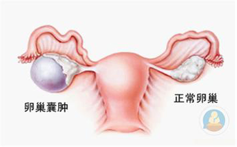 卵巢囊腫，抱腿壓涌泉穴，給你愛心呵護(hù)