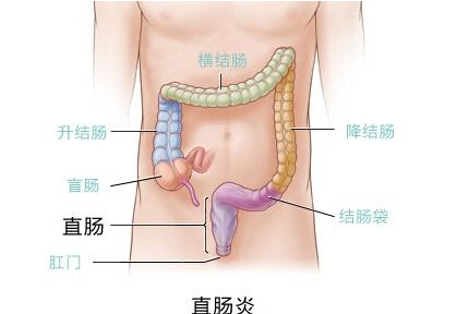 瘍潰瘍性結(jié)腸炎的拔罐療法